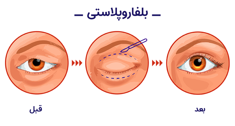 عمل بلفاروپلاستی چیست؟