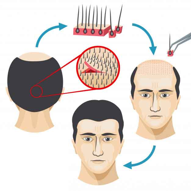 مراحل کاشت موی طبیعی