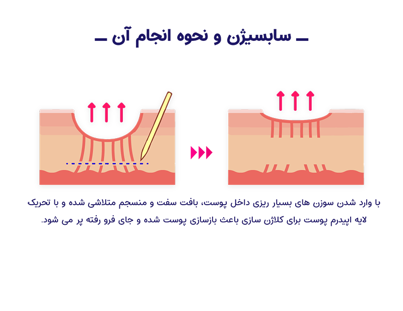 سابسیژن چیست؟